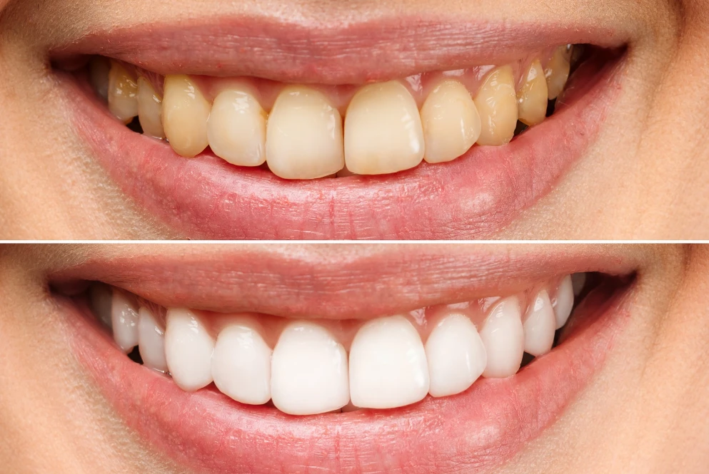 Sorriso prima e dopo il trattamento